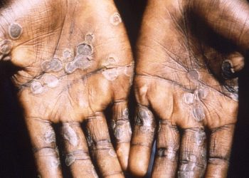 Africa Trapped by MPOX Outbreak
