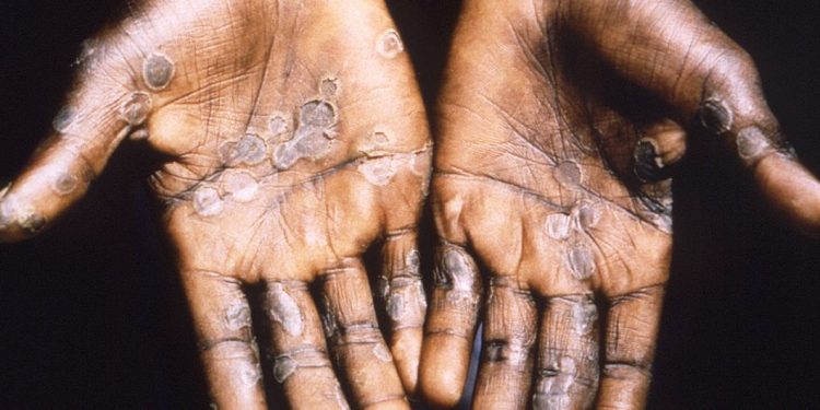 Africa Trapped by MPOX Outbreak