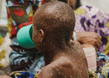 MPOX Emergency: Equitable Vaccine Access Crucial for Global South