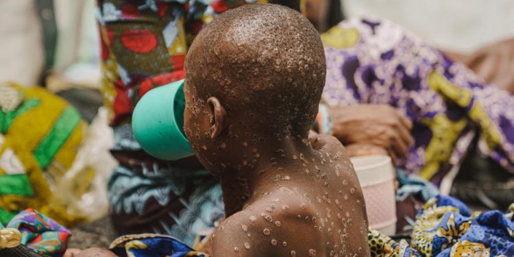 MPOX Emergency: Equitable Vaccine Access Crucial for Global South